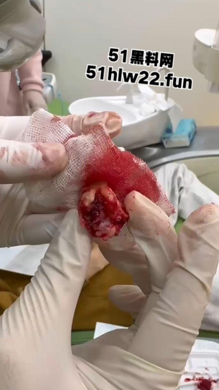 口腔医院逆天操作,客人拔智齿结果医生不分青红皂白直接大力出奇迹, 把上颌骨拔断撤了下来!-1